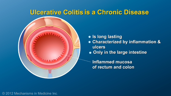 Slide Show - What is Ulcerative Colitis?