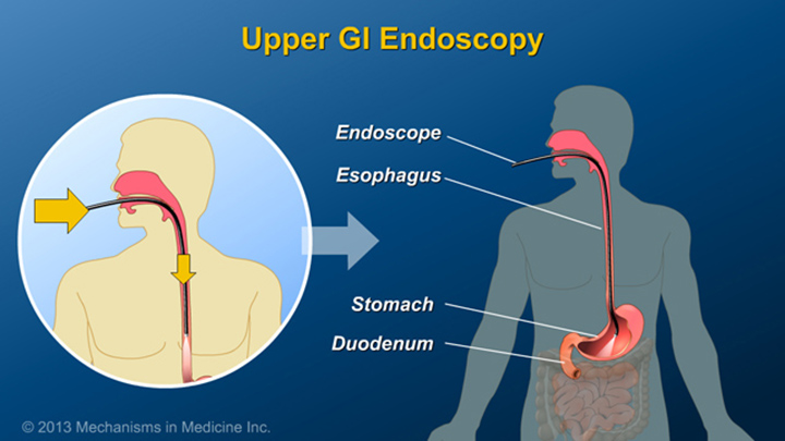 Upper GI Endoscopy