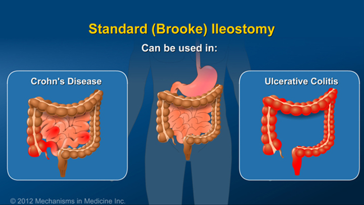 Standard (Brooke) Ileostomy for IBD