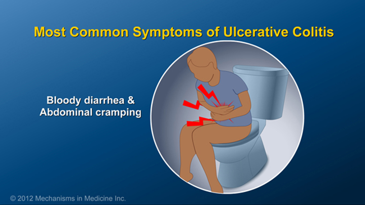 Common Symptoms of Ulcerative Colitis