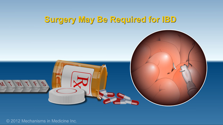 Surgery may be required for IBD
