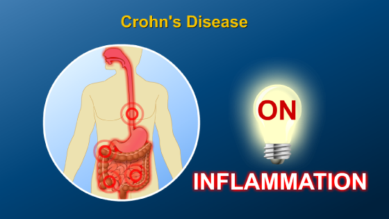 Animation - What is Crohn’s Disease?