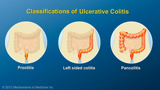 Animation - What is Ulcerative Colitis?