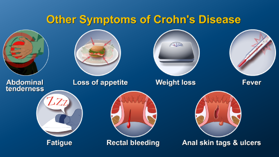 Slide Show - What is Crohn’s Disease?