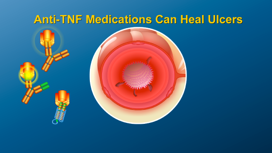 Animation - Anti-TNF IBD Therapy