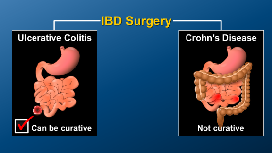 Surgery and IBD