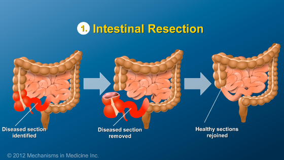 Slide Show - Small Bowel and Large Bowel Surgery for IBD
