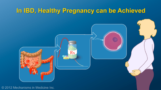 Slide Show - Optimizing Pregnancy Outcomes with IBD