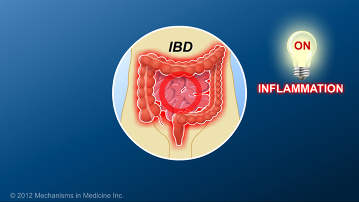 Chronic inflammation and IBD