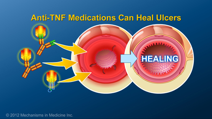 IBD Anti-TNF Medications