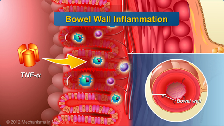 Ulcerations in the Gut and IBD