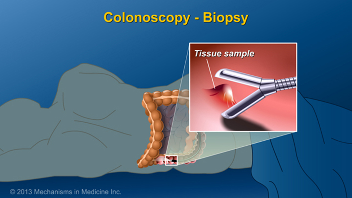Colonoscopy - Biopsy