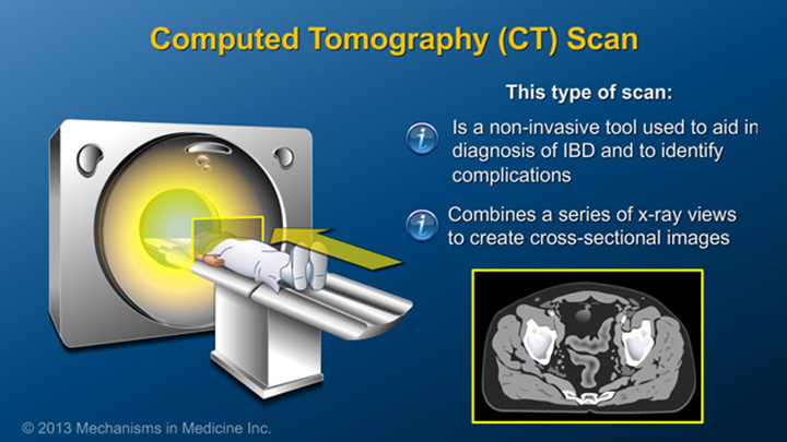 Computer Tomography (CT) Scan