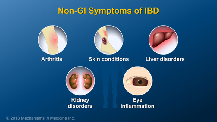 GI Symptoms of IBD