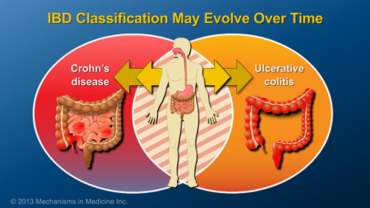 IBD Classification may Evolve Over Time