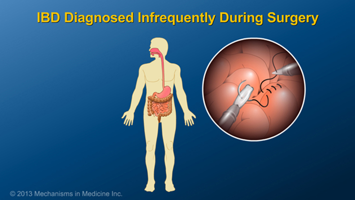 IBD Diagnosted Infrecquently During Surgery