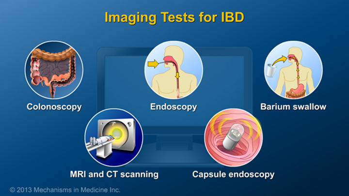 Imaging Tests for IBD