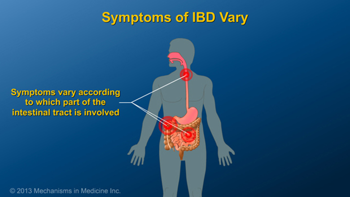Symptoms of IBD vary