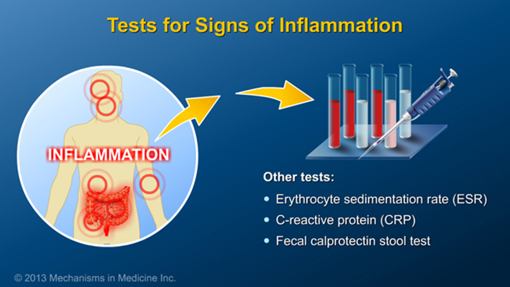 Tests for Signs of Inflamation