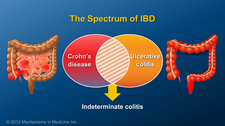 Spectrum of IBD 
