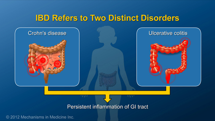 Two Disorders of IBD