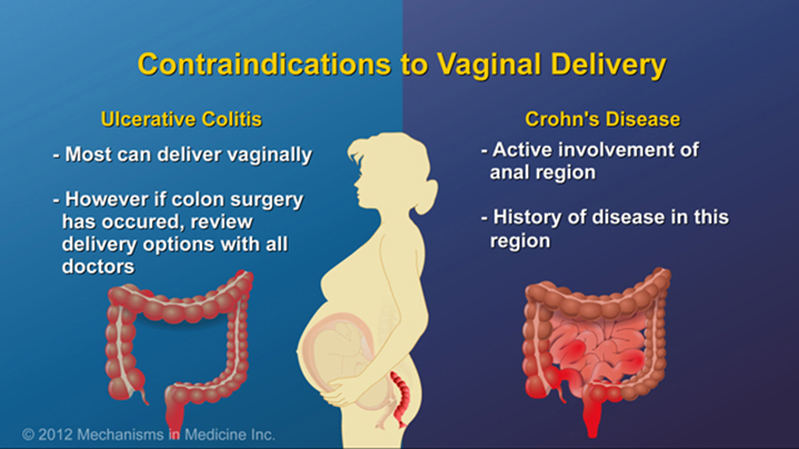 Contraindications to Vaginal Delivery and IBD