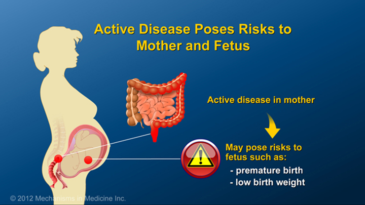 IBD Risks to Mother and Fetus