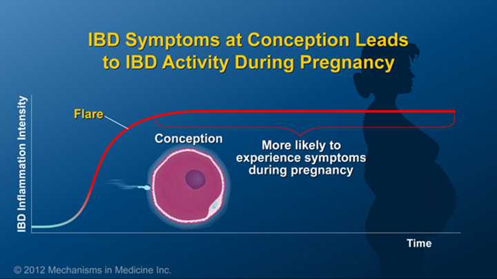 IBD Symptoms at Conception