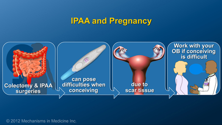 IPAA and Pregnancy for IBD