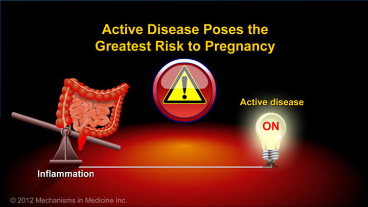 Risk to Pregnancy and IBD