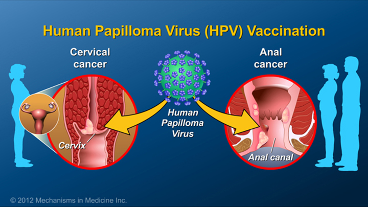 HPV and IBD