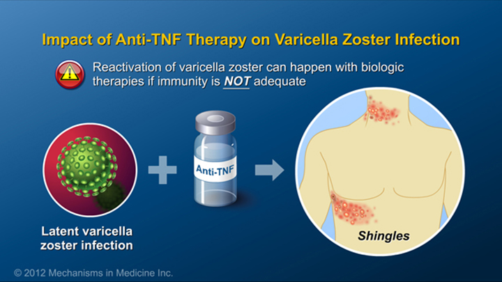 Varicella Zoster and IBD Therapy