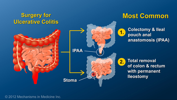 Common Ulcerative Colitis Surgeries