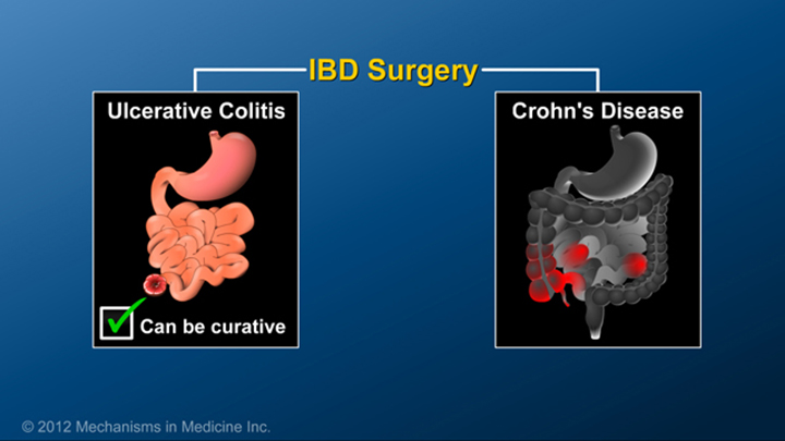 IBD Surgery