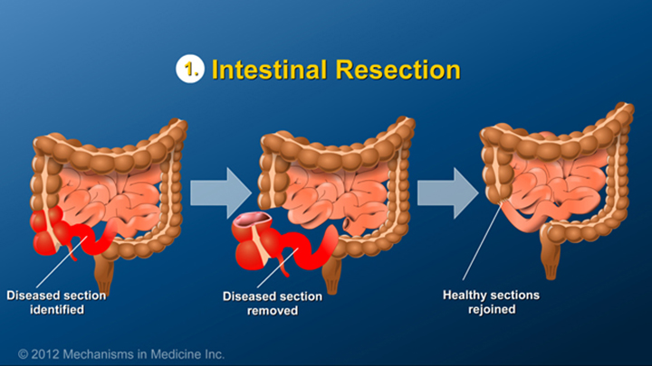 Intestinal Resection for IBD