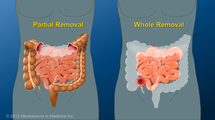 Partial or Complete Bowel Removal and IBD