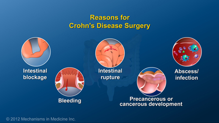 Reasons for Crohn’s Surgery