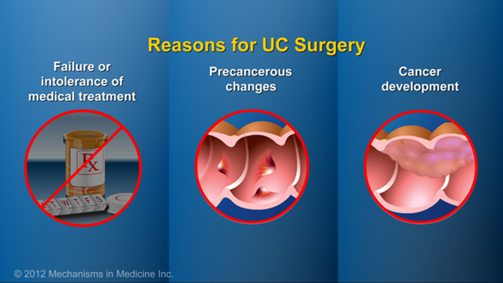 Reasons for Ulcerative Colitis Surgery