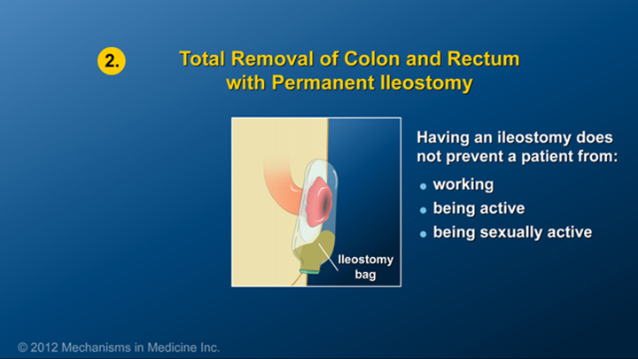 Removal of Colon and Rectum for IBD