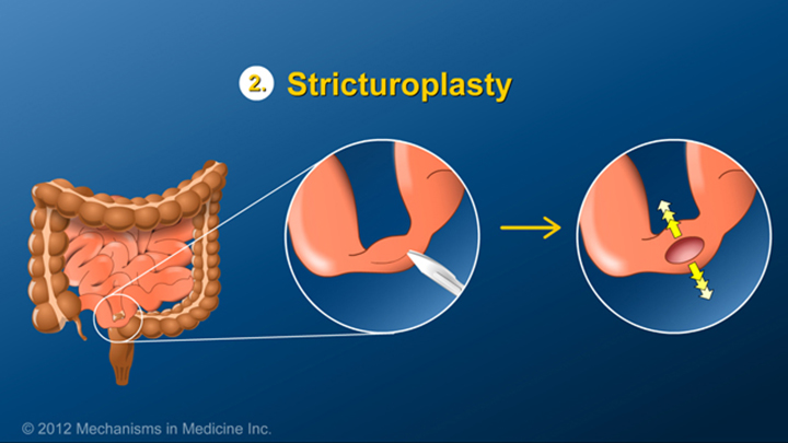 Stricturoplasty and IBD
