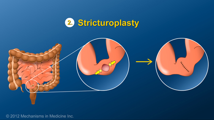 Stricturoplasty Procedure and IBD