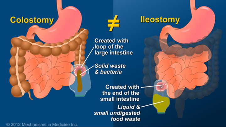 IBD Ileostomy vs. Colostomy