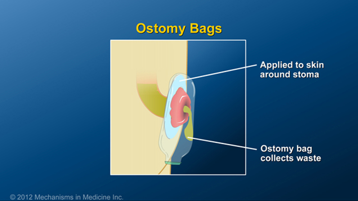 Ostomy Bags and IBD