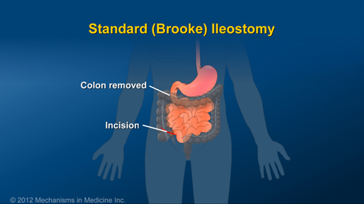 Standard (Brooke) Ileostomy Procedure IBD