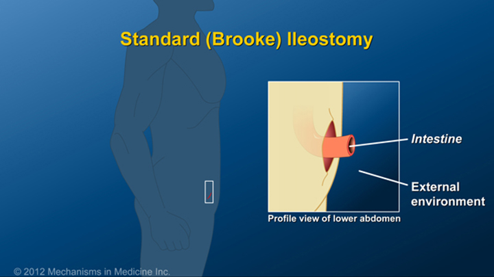 Standard (Brooke) Ileostomy Procedure IBD 