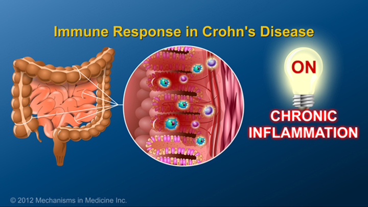 Immune Response in Crohn’s
