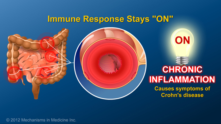 Immune Response in Crohn’s