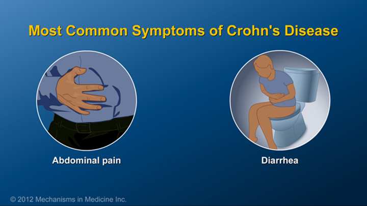 Most Common Symptoms of Crohn’s