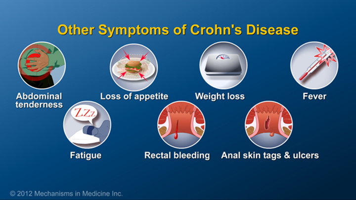 Other Symptoms of Crohn’s