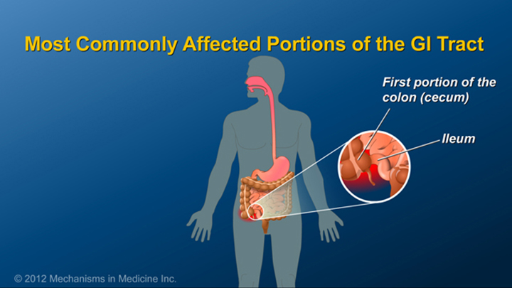 Portions of GI Tract and Crohn’s
